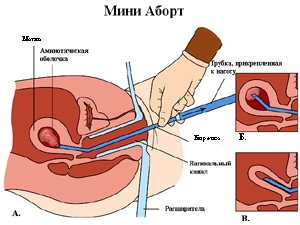 Avortul, mini-avortul, avortul și consecințele acestuia