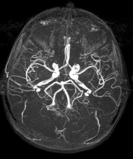 Contraindicație angiografie a arterelor și venelor, diagnosticul de mrd și uzi în tagil inferior