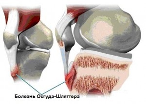 Осгуд-Schlatter болест на групата на коляно-риск, симптоми и лечение