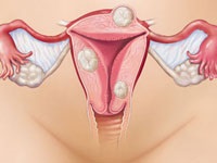 Borovoy uterus cu myomas - comentarii cum să luați