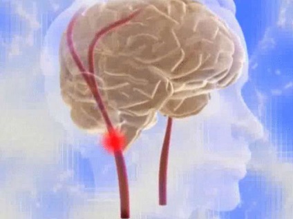 Arterele brahiocefalice și accidentul cerebrovascular