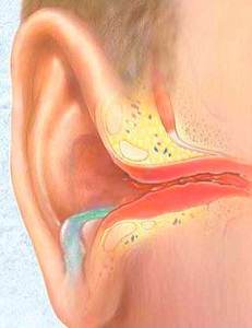 Bursită simptome, clasificare, diagnostic și tratament