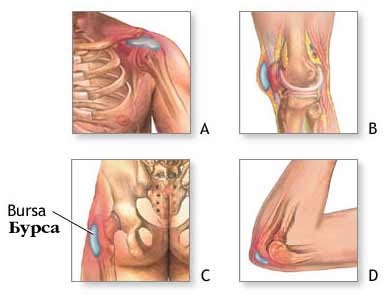 Bursita articulațiilor - cauze, simptome și tratament