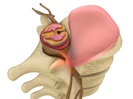 Care este proeminența discurilor intervertebrale ale coloanei vertebrale lombare