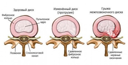 Care este proeminența discurilor intervertebrale ale coloanei vertebrale lombare