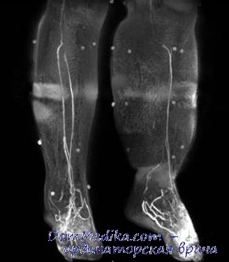 Az elephantiasis diagnosztikája