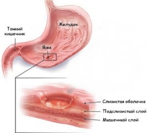 Dieta după tratamentul chirurgical al ulcerului stomacal