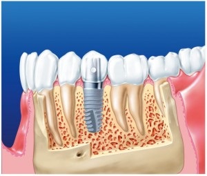 Asigurarea suplimentară pentru protezele dentare, toate știrile din stomatologie
