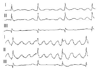 Ekr cu flutter atrial pe eq în loc de dinți p sunt determinate