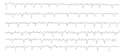 Ekr cu flutter atrial pe eq în loc de dinți p sunt determinate