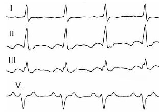 Ekr cu flutter atrial pe eq în loc de dinți p sunt determinate