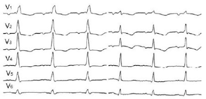 Ekr cu flutter atrial pe eq în loc de dinți p sunt determinate