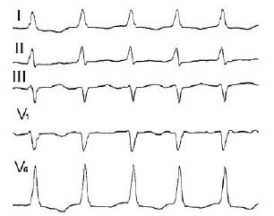 Ekr cu flutter atrial pe eq în loc de dinți p sunt determinate