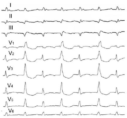 Ekr cu flutter atrial pe eq în loc de dinți p sunt determinate