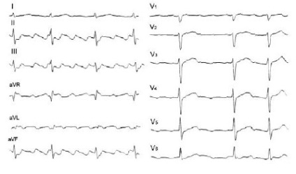 Ekr cu flutter atrial pe eq în loc de dinți p sunt determinate