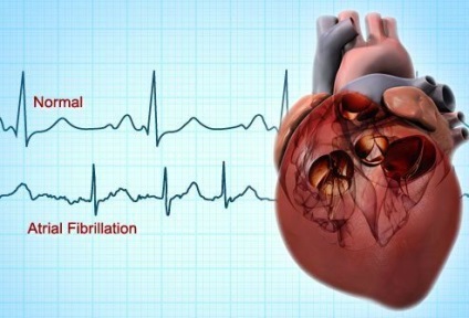 Fibrilația atrială în imagini