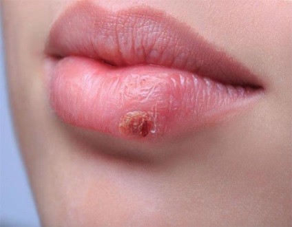 Herpesz az ajkán a terhesség alatt - mi a veszély