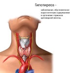 Pajzsmirigy-hypothyreosis