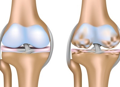Gonartroză de gradul trei al articulației genunchiului