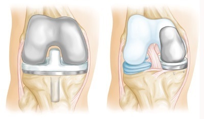 Gonartroză de gradul trei al articulației genunchiului