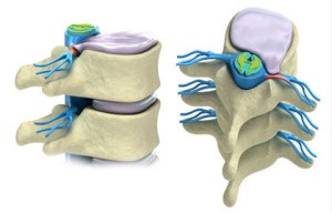 Hernia departamentului sacral - simptome, diagnostic, tratament - clinica medicului Ignatiev g