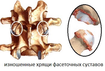 Spondilartroza spinării toracice - simptome și tratament