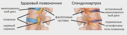 Spondilartroza spinării toracice - simptome și tratament
