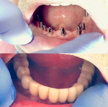 Implantarea tipurilor de dinți și a prețurilor în reduceri Krasnodar