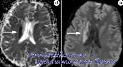 Accidente vasculare cerebrale la copii, diagnostic, tratament