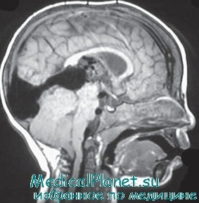 Strokes la nou-născuți - epidemiologie, clasificare