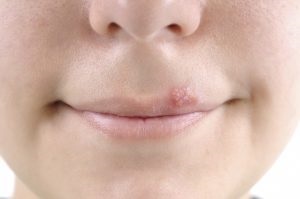 Cum să scapi de herpes acasă - lumea femeilor