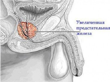 Cum se manifestă ea însăși și cum este tratată inflamația cronică a prostatei?