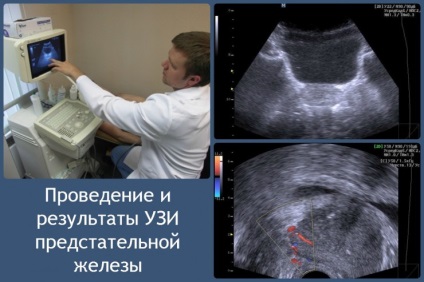 Как се проявява и как тя се третира с хронично възпаление на простатата, видео