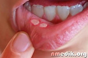 Cum să vindeci aphthae în gură