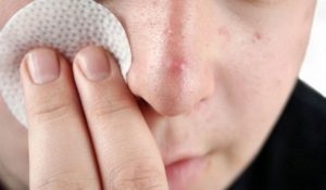 Acarianul demodex pe cauzele feței și metodele de tratament