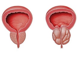Semnele cheie ale bolii de prostată
