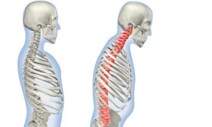 Tratamentul spondilitei anchilozante într-un centru medical european din Moscova