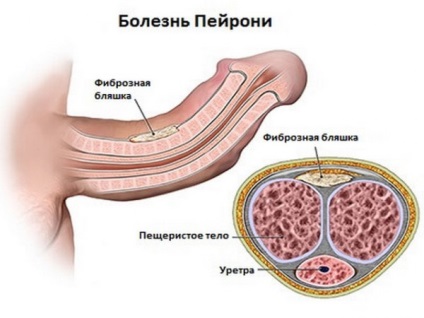 Tratamentul bolii peyronie la Moscova
