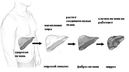 Tratamentul hepatozei hepatice cu remedii folclorice