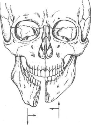 Tratamentul unei fracturi a maxilarului inferior
