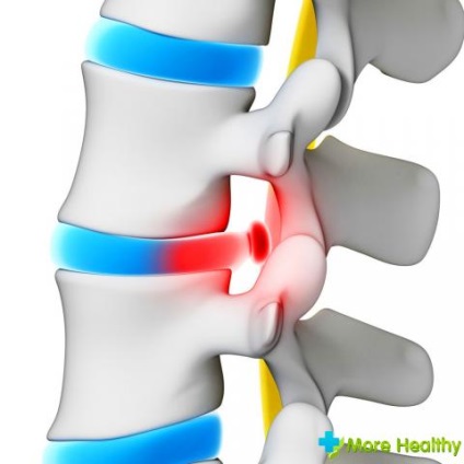 Tratamentul herniei vertebrale