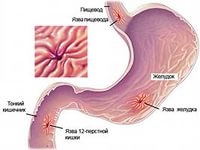 Tratamentul ulcerului duodenal cu remedii folclorice, tratament cu remedii folclorice