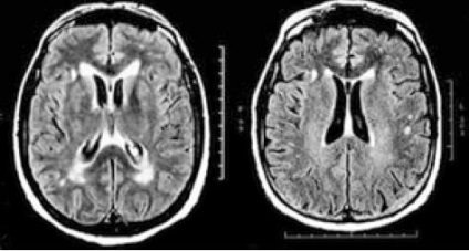 Imagistica prin rezonanță magnetică a creierului și a vaselor cerebrale