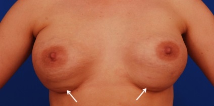 Mamoplastia pe fotografie - înainte și după, reducere, lenjerie de compresie, bule dublă, cusături, verticală