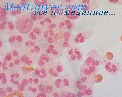 Meningitis és meningoencephalitis meningococcemia (meningococcemia) nélkül Meningitis és Meningoencephalitis meningococcemia nélkül