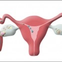 Lunar pentru miomul uterin, ce să faceți