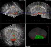 Procedura de utilizare a chimioterapiei în tratamentul cancerului de prostată în stadiul 4