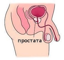 Procedura de utilizare a chimioterapiei în tratamentul cancerului de prostată în stadiul 4