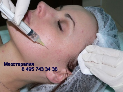 Mesoterapie acnee facială, riduri, adipos, acnee subcutanată, cosmetologie