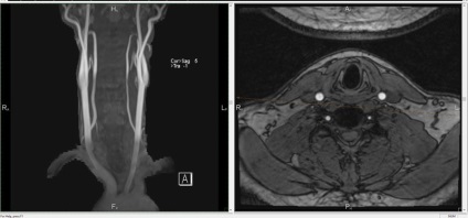 A nyaki gerinc artériájának és vénájának ára kontraszttal,